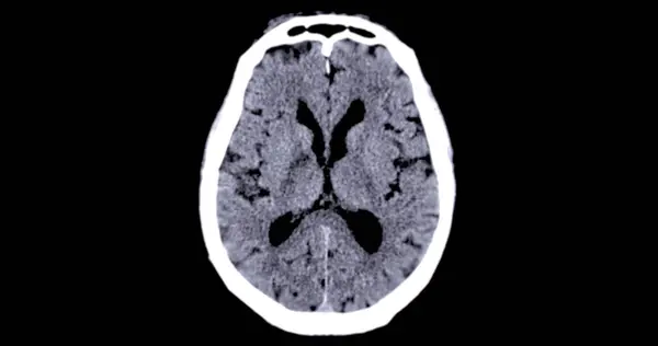 診断脳腫瘍 ストローク病および血管疾患のための脳軸平面のCtスキャン — ストック写真