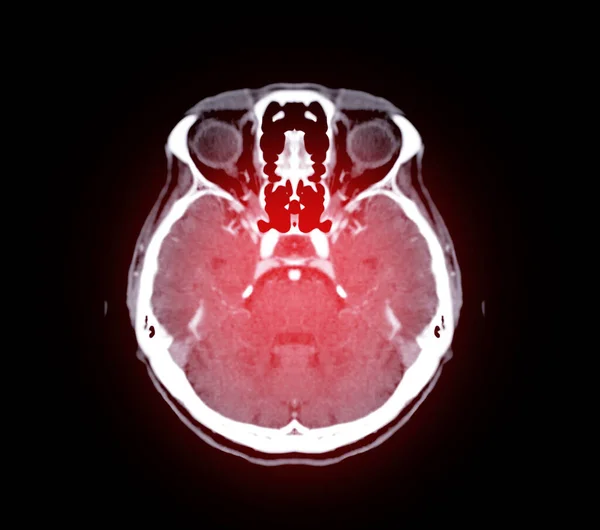 Scan Van Hersenen Axiaal Vlak Voor Diagnose Hersentumor Beroerte Ziekten — Stockfoto