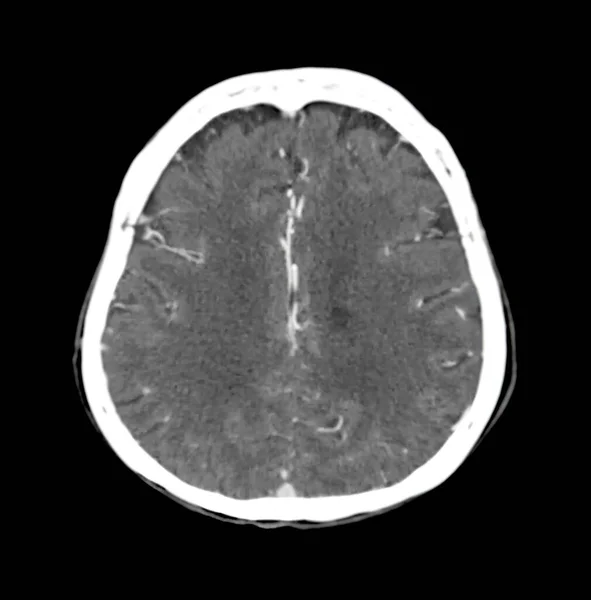 Tomografia Komputerowa Mózgu Osiowa Płaszczyzna Diagnozy Guza Mózgu Udaru Mózgu — Zdjęcie stockowe