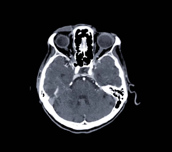 Computertomographie Des Gehirns Axiale Ebene Zur Diagnose Von Hirntumor Schlaganfallerkrankungen — Stockfoto