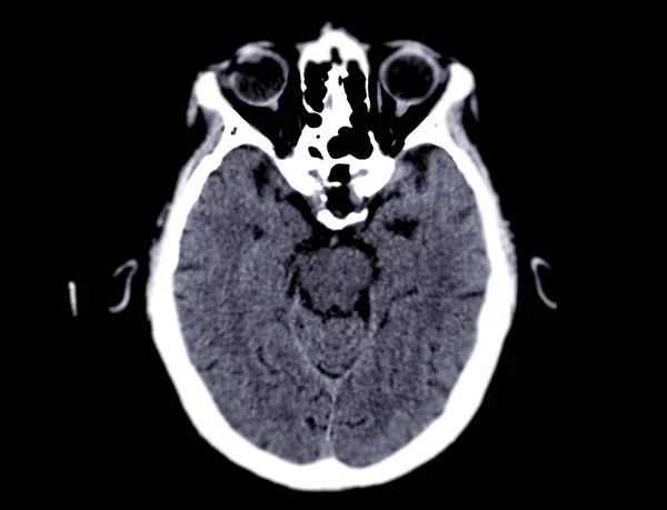 Осевой Плоскости Мозга Диагностики Опухоли Головного Мозга Инсультных Заболеваний Сосудистых — стоковое фото