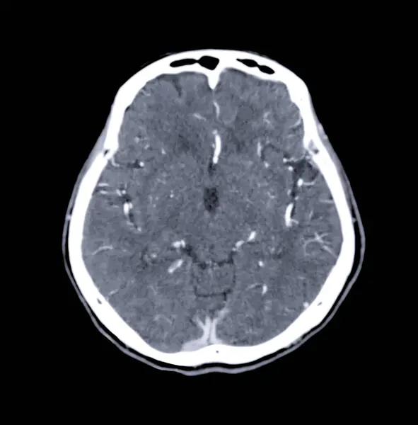 Сканування Мозку Осьова Площина Діагностики Пухлини Мозку Інсультних Захворювань Судинних — стокове фото