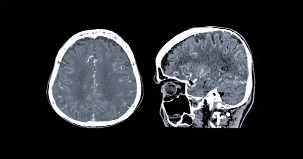 Tomografia Computadorizada Cérebro Axial Plano Sagital Para Diagnóstico Tumor Cerebral — Fotografia de Stock