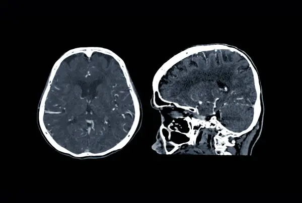 Scan Van Hersenen Axiaal Sagittale Vlak Voor Diagnose Hersentumor Beroerte — Stockfoto