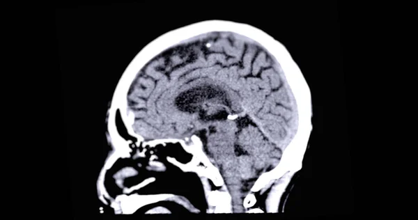 Scan Der Gehirnsagittalebene Zur Diagnose Von Hirntumor Schlaganfallerkrankungen Und Gefäßerkrankungen — Stockfoto