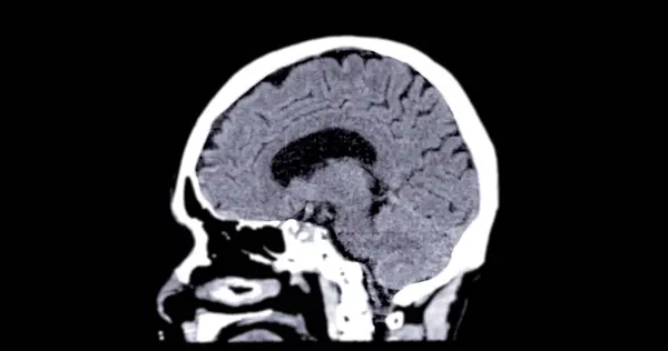 Tomografia Computadorizada Plano Sagital Cérebro Para Diagnóstico Tumor Cerebral Doenças — Fotografia de Stock