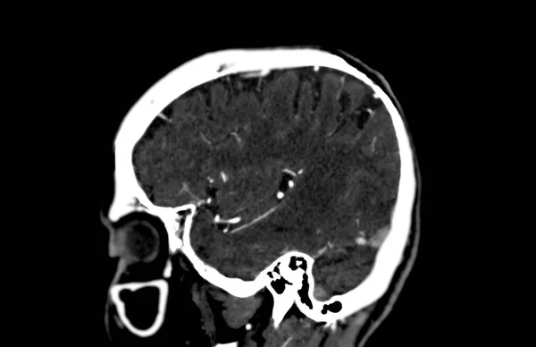 Scan Van Hersenen Sagittale Vlak Voor Diagnose Hersentumor Beroerte Ziekten — Stockfoto