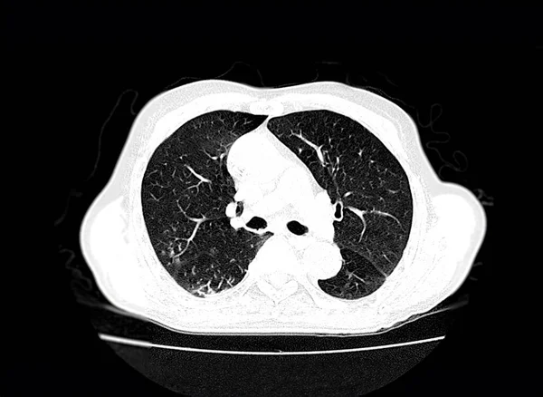 診断パルモナリエンボリズム 肺がんおよびコビド 19に対する胸軸視のCtスキャン — ストック写真