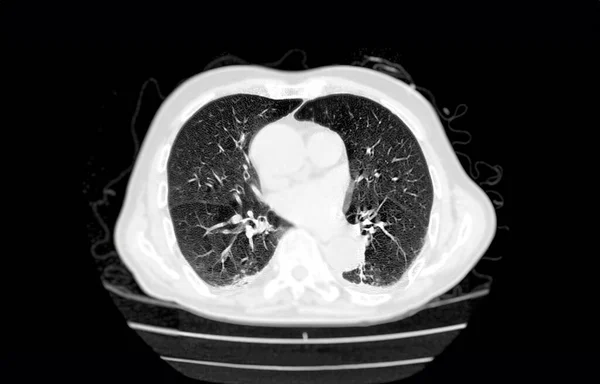 Tomografia Computadorizada Tórax Axial Para Diagnóstico Embolia Pulmonar Câncer Pulmão — Fotografia de Stock