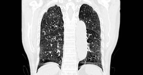 Scan Van Coronaal Borstbeeld Voor Diagnostisch Longembolie Longkanker Covid — Stockfoto