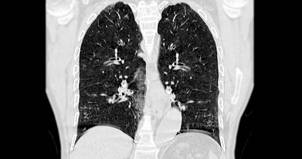 Tomografia Computadorizada Tórax Vista Coronal Para Diagnóstico Embolia Pulmonar Câncer — Fotografia de Stock