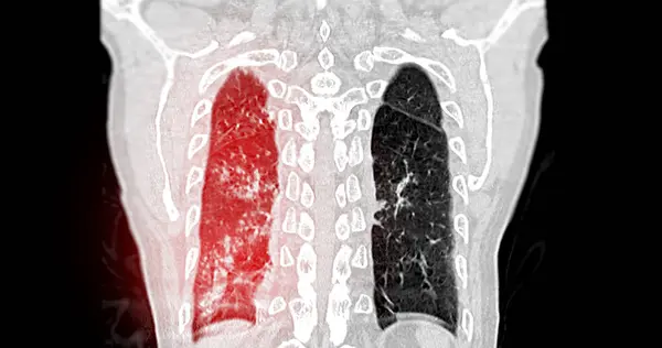 Сканування Коронального Зору Грудної Клітини Діагностики Легенева Емболія Рак Легень — стокове фото