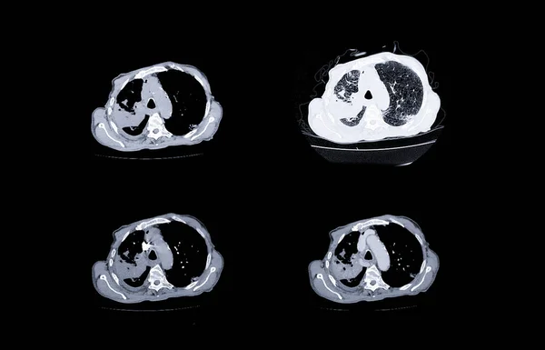 Tętnica Płucna Ctpa Lub Cta Diagnostyki Zatorowości Płucnej Raka Płuc — Zdjęcie stockowe