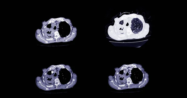 Ctpa Cta Artéria Pulmonar Para Diagnóstico Embolia Pulmonar Câncer Pulmão — Fotografia de Stock