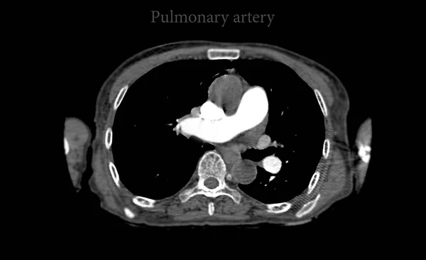 Ctpa Cta Arteria Pulmonar Para Diagnóstico Embolia Pulmonar Cáncer Pulmón —  Fotos de Stock