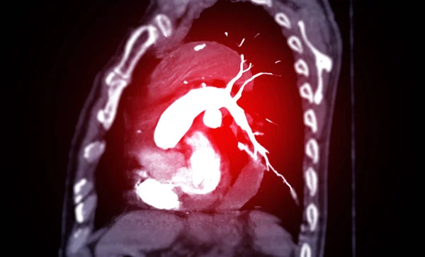 CtpaまたはCta肺動脈 肺癌およびコビド 19の診断のための肺動脈 — ストック写真
