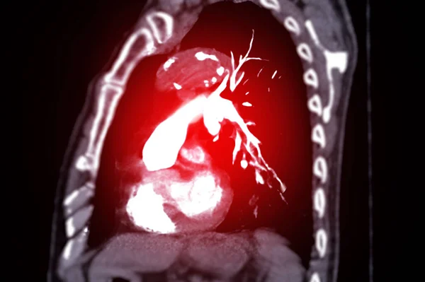 Ctpa或Cta肺动脉用于诊断肺栓塞 肺癌和Covid — 图库照片