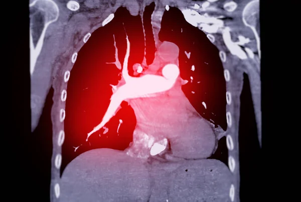 CtpaまたはCta肺動脈 肺癌およびコビド 19の診断のための肺動脈 — ストック写真
