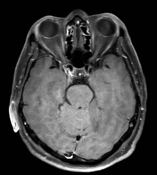 Мрт Мозга Сканирование Осевой Плоскости Обнаружения Суши Болезни Мозга Инсульта — стоковое фото