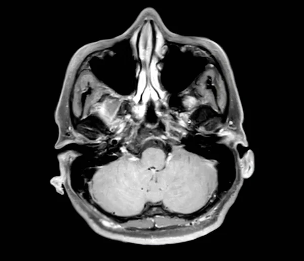 Мрт Мозга Сканирование Осевой Плоскости Обнаружения Суши Болезни Мозга Инсульта — стоковое фото