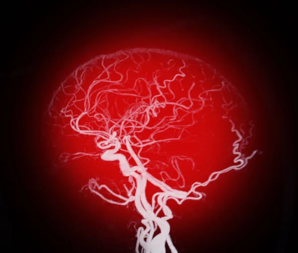 Angiografie Mozku Nebo Mozku Cta Ukazující Mozkovou Artérii — Stock fotografie