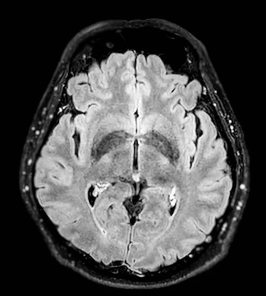 Мрт Мозок Сканує Осьову Площину Чутливості Виявлення Захворювань Мозку Інсультних — стокове фото