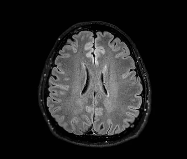 Mrt Gehirn Scan Axiale Flair Ebene Zur Erkennung Von Gehirnerkrankungen — Stockfoto