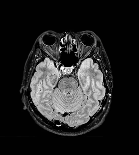 Scanarea Creierului Rmn Planul Axial Inului Pentru Detectarea Bolilor Cerebrale — Fotografie, imagine de stoc