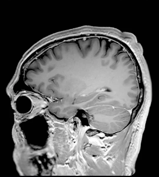 Мрт Мозок Сканує Сагітальну Площину T1W Виявлення Захворювань Мозку Інсультних — стокове фото