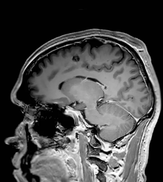 Мрт Мозок Сканує Сагітальну Площину T1W Виявлення Захворювань Мозку Інсультних — стокове фото