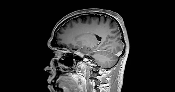 Mri Cérebro Varredura Sagital Plano T1W Para Detectar Doenças Cerebrais — Fotografia de Stock