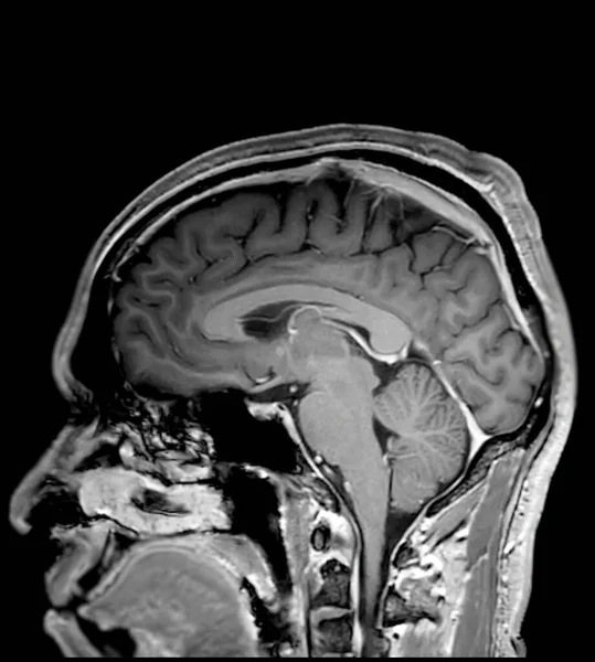 Мрт Мозга Сканирования Сагиттальной T1W Плоскости Обнаружения Заболеваний Мозга Сухой — стоковое фото