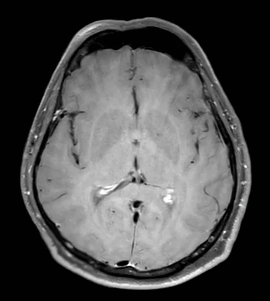 Мрт Мозок Сканує Осьовий Swi Виявлення Захворювань Головного Мозку Інсультних — стокове фото