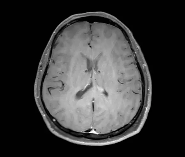 Scanarea Creierului Rmn Swi Axial Pentru Detectarea Bolilor Cerebrale Susțin — Fotografie, imagine de stoc