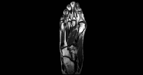 Mri Foot Skanowanie Coronal View Technika Diagnostycznego Urazu Ścięgna — Zdjęcie stockowe