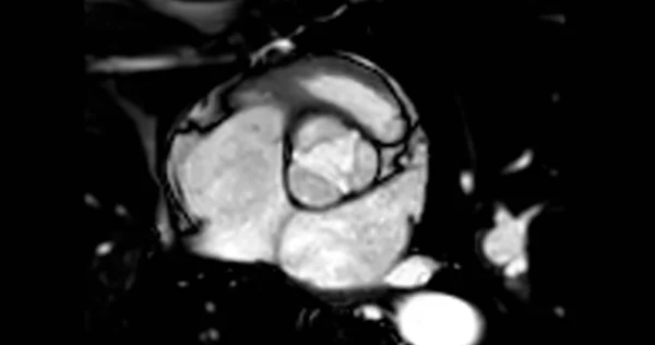 Mri Srdce Nebo Srdeční Mri Magnetická Rezonance Srdce Ukazuje Aortální — Stock fotografie