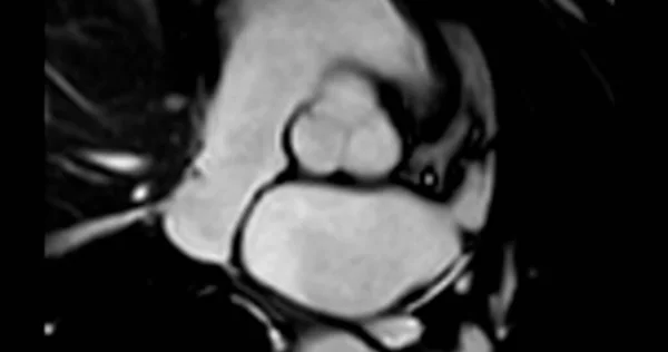 心脏Mri或心肌Mri 磁共振成像 显示主动脉瓣 — 图库照片