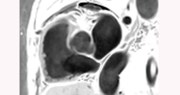 心脏Mri或心肌Mri 磁共振成像 显示主动脉瓣 — 图库照片