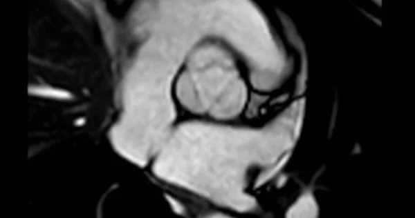 Mri Srdce Nebo Srdeční Mri Magnetická Rezonance Srdce Ukazuje Aortální — Stock fotografie