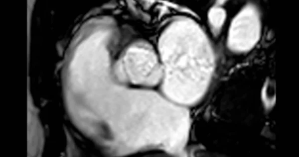 Mrt Herz Oder Herz Mrt Magnetresonanztomographie Des Herzens Mit Aortenklappe — Stockfoto