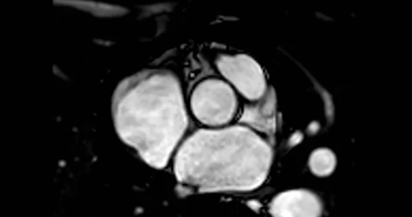Mri Καρδιάς Μαγνητική Τομογραφία Μαγνητική Τομογραφία Της Καρδιάς Δείχνει Αορτική — Φωτογραφία Αρχείου
