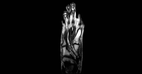 Мрт Foot Сканування Техніка Коронального Зору Діагностичної Травми Сухожилля — стокове фото