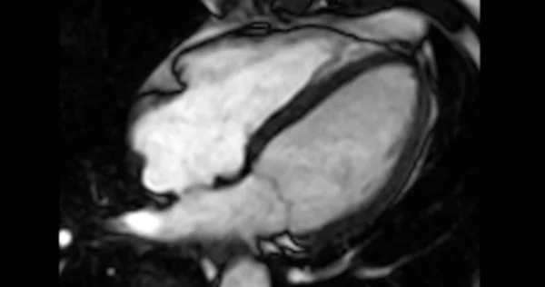 Mri Heart Cardiac Mri Magnetic Resonance Imaging Heart Short Axis — Stock Photo, Image