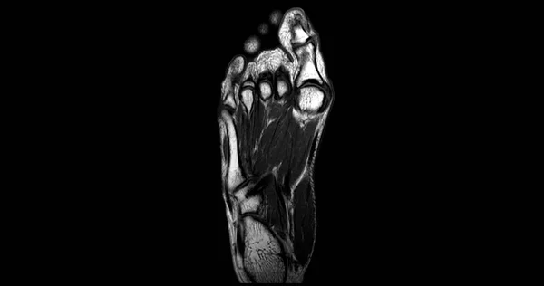Mri Foot Scan Coronal View Technique Diagnostic Tendon Injury — Stock Photo, Image