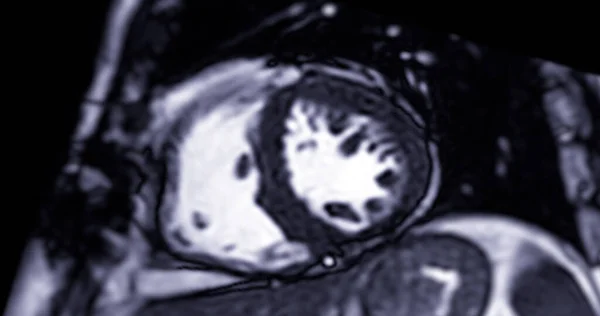 2室心脏跳动短轴Mri 磁共振成像 检测心脏病的实验研究 — 图库照片