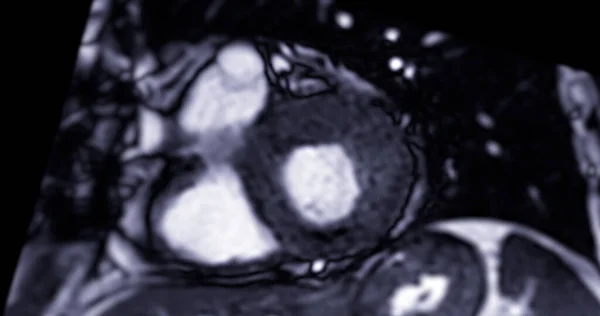 MRI heart or Cardiac MRI ( magnetic resonance imaging ) of heart in Short axis  view showing heart beating of  2 chamber for detecting heart disease.
