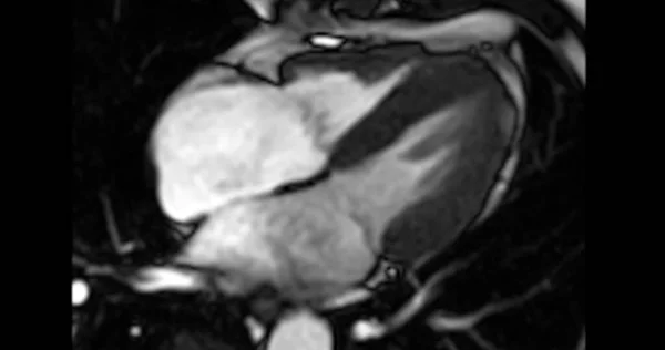 MRI heart or Cardiac MRI ( magnetic resonance imaging ) of heart in Short axis  view showing heart beating of  4 chamber for detecting heart disease.