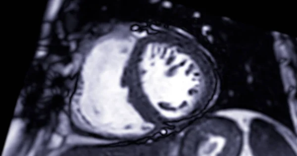 Mri Heart Cardiac Mri Magnetic Resonance Imaging Heart Short Axis — Stock Photo, Image