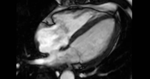 Mri Srdce Nebo Srdeční Mri Magnetická Rezonance Srdce Krátkém Úhlu — Stock fotografie
