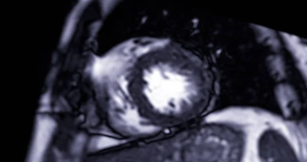 Mri心臓または心臓Mri 心臓共鳴イメージング 短軸ビューでは心臓病を検出するための心臓2室の鼓動を示しています — ストック写真